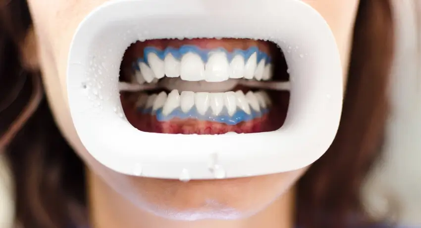 Professional Teeth Whitening: Discover the Power of a Brighter Smile
