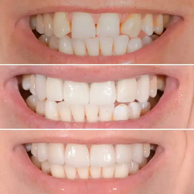 Professional Teeth Whitening: Discover the Power of a Brighter Smile