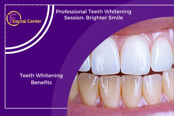 Professional Teeth Whitening: Discover the Power of a Brighter Smile
