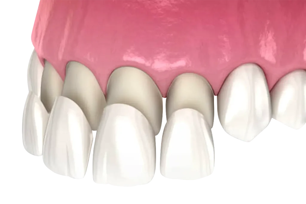 Prosthodontic Treatment: Restore Confidence by Replacing Missing Teeth