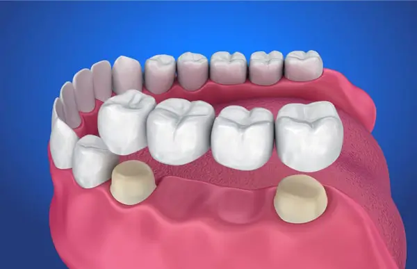 Prosthodontic Treatment: Restore Confidence by Replacing Missing Teeth
