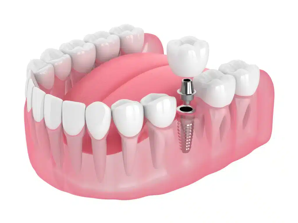 Prosthodontic Treatment: Restore Confidence by Replacing Missing Teeth