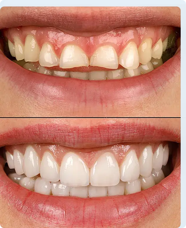 Prosthodontic Treatment: The Path to Complete Smile Restoration