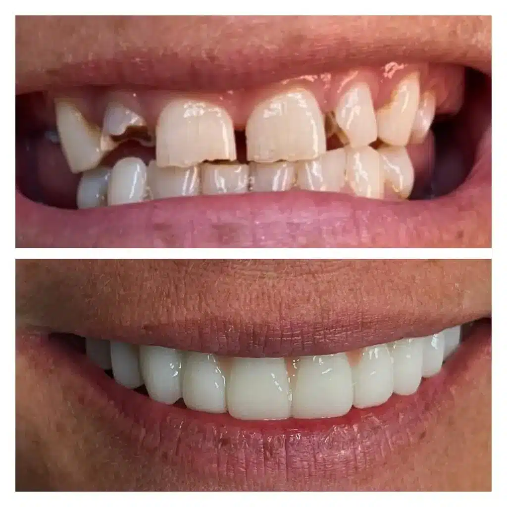 Prosthodontic Treatment: The Path to Complete Smile Restoration