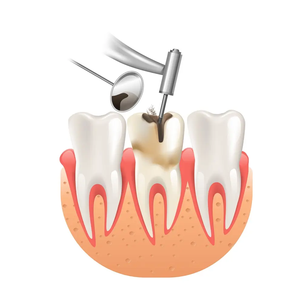 Root Canal Treatment: Advanced Endodontic Procedures for Healthy Teeth