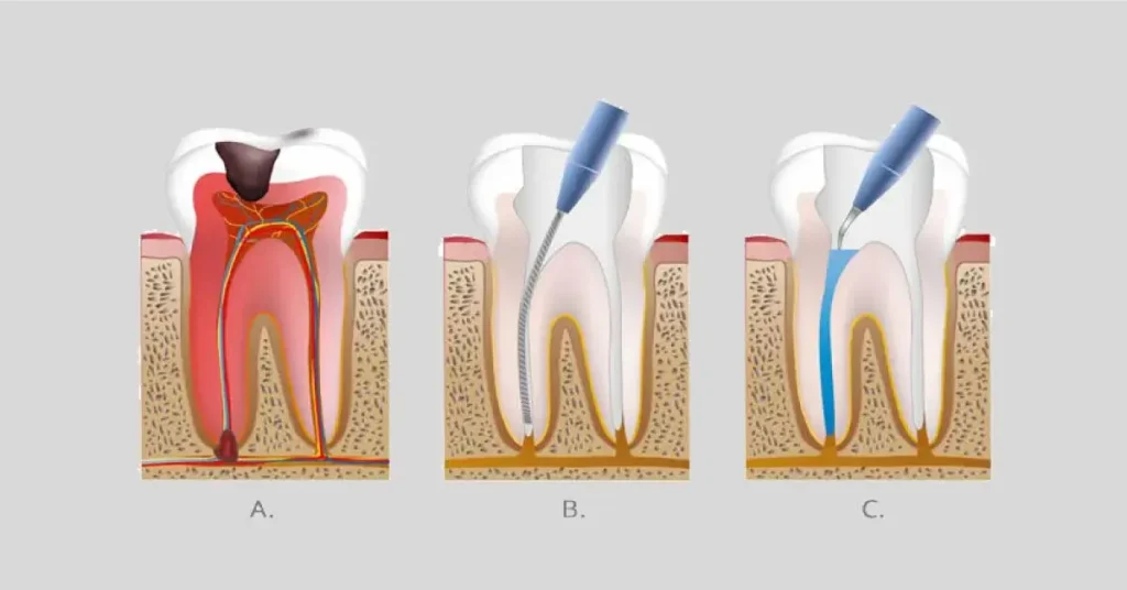Root Canal Treatment: Your Best Solution for Tooth Nerve Pain Relief