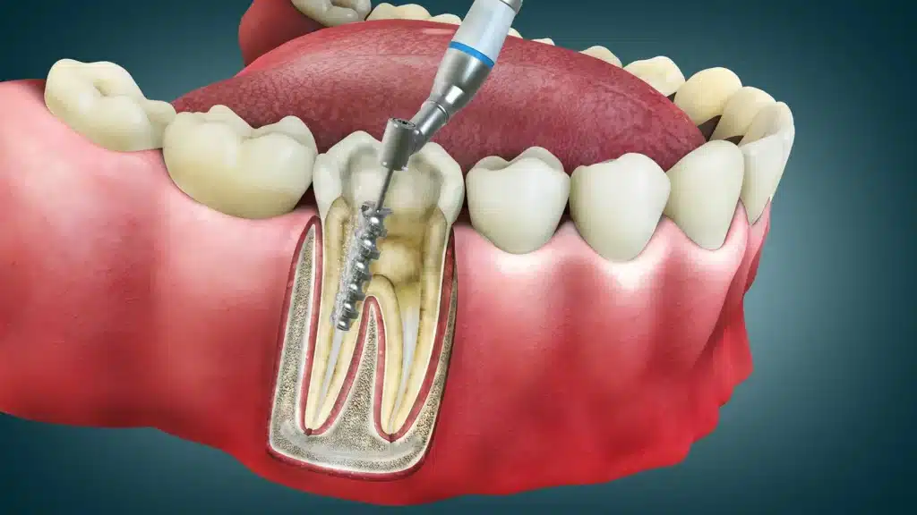 Root Canal Treatment Your Best Solution for Tooth Nerve Pain Relief