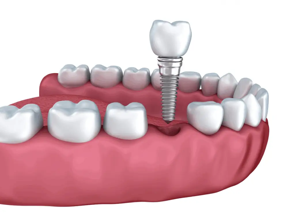 Root Canal Treatment Your Best Solution for Tooth Nerve Pain Relief