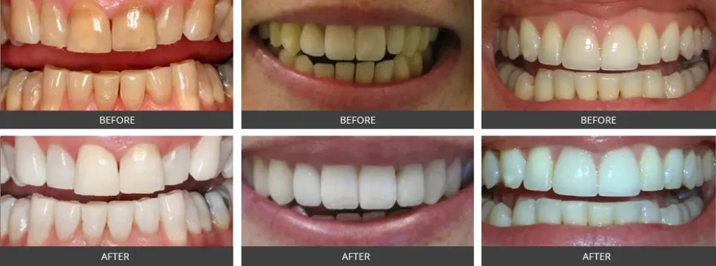 Teeth Whitening: Safe & Effective Methods for a Brighter Smile