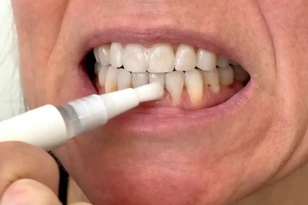 Safe Teeth Whitening: What Works and What Doesn’t?