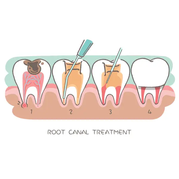 Root canal treatment