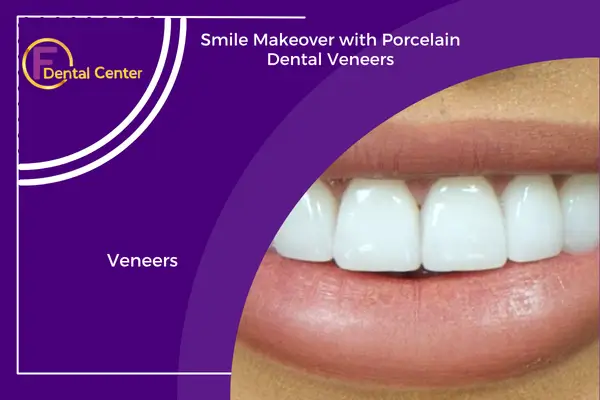 Dental Veneers and the Smile Makeover Revolution