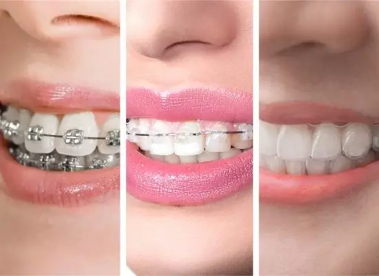 The Benefits of Invisible Braces Over Traditional Braces
