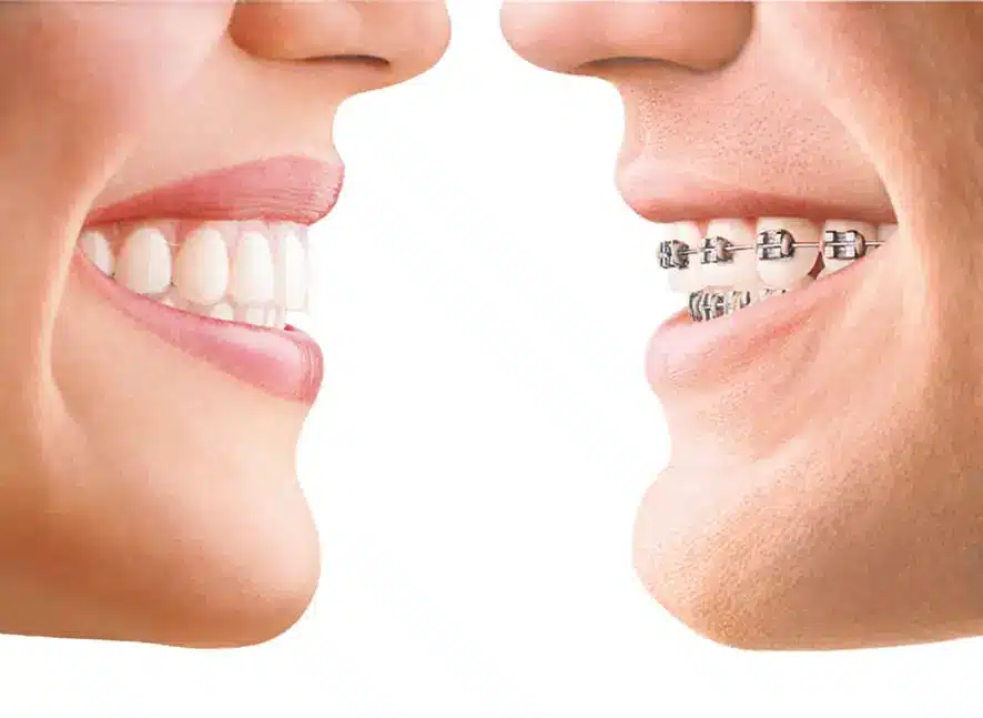 The Benefits of Invisible Braces Over Traditional Braces