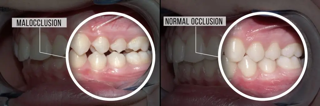 The Effect of teeth grinding on gums and Bones: What You Need to Know