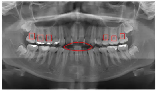 The Role of Panoramic X-rays and CT Scans in Diagnosing Oral Damage