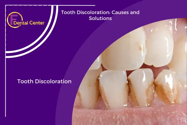 Tooth Discoloration: Causes and Solutions