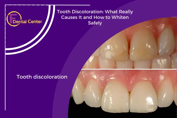 Tooth Discoloration: What Really Causes It and How to Whiten Safely