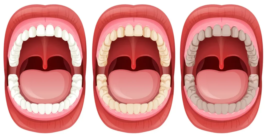 Tooth Erosion Caused by Poor Oral Hygiene and Bruxism