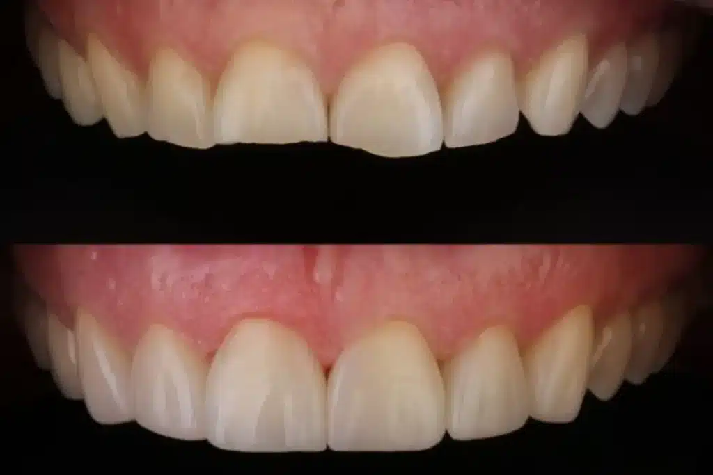 Tooth Erosion Caused by Poor Oral Hygiene and Bruxism