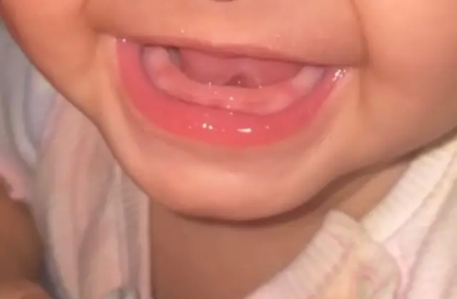 Tooth Eruption Delay in Infants: What It Means and When to Act