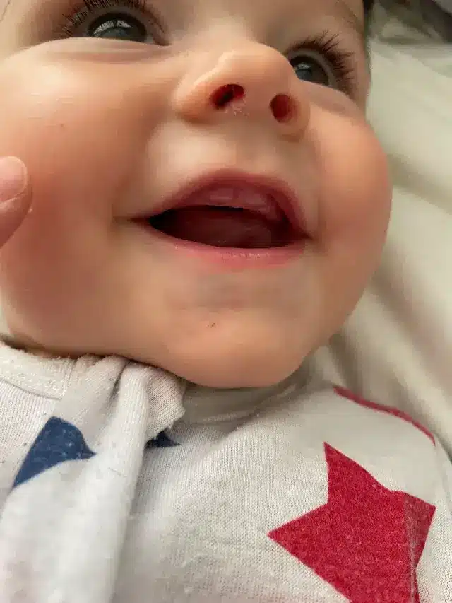Tooth Eruption Delay in Infants: What It Means and When to Act
