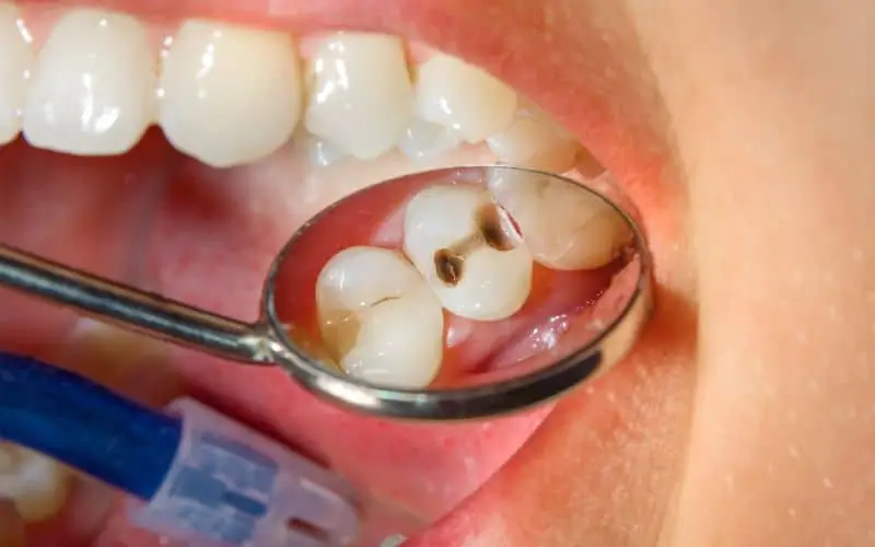 Understanding Common Dental Diseases and Their Impact