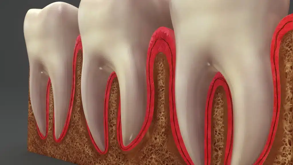 Advanced Gum Disease Treatments for Severe Gum Disease