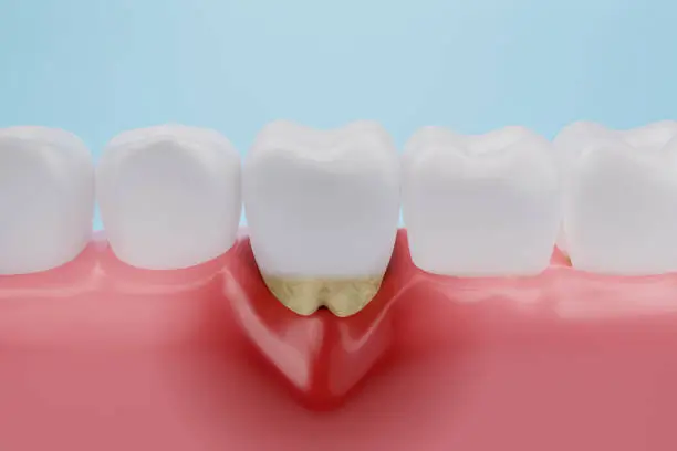 Understanding Severe Gum Disease: A Silent Threat