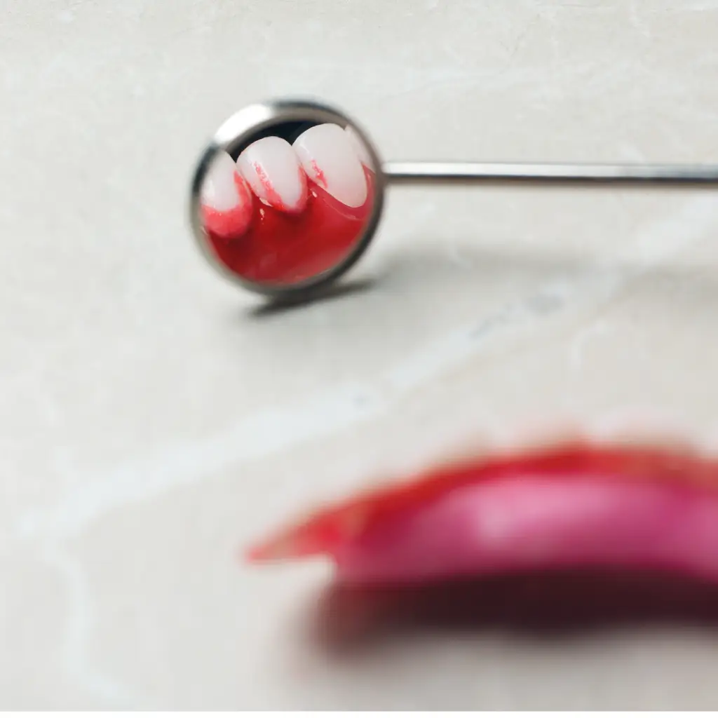 Advanced Gum Disease Treatments for Severe Gum Disease