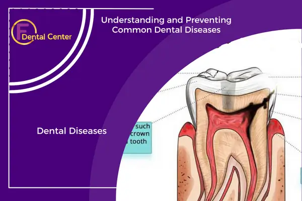 Understanding Common Dental Diseases and Their Impact