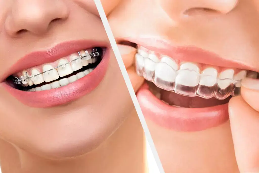 The Benefits of Invisible Braces Over Traditional Braces