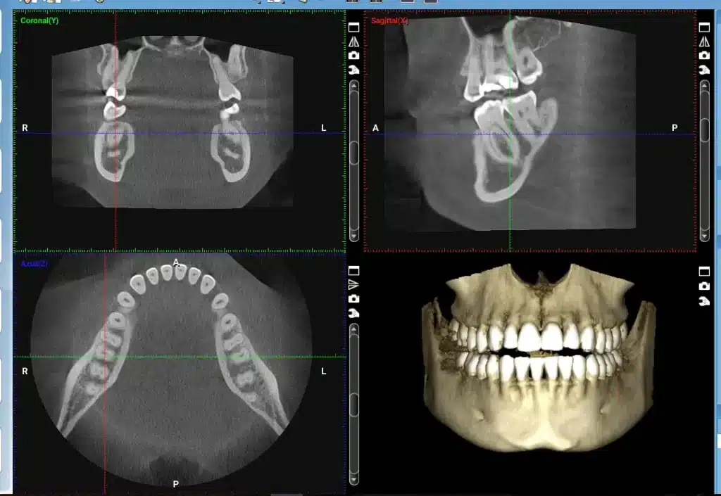 Why Dental Imaging Accuracy Is Crucial Before Treatment