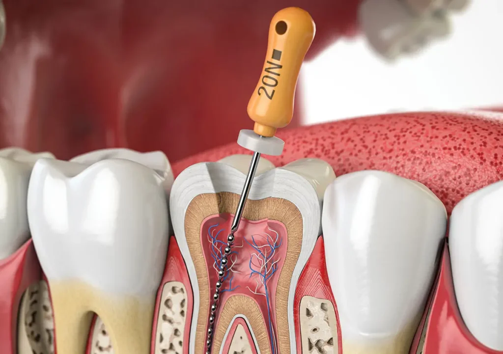 Tooth nerve pain relief