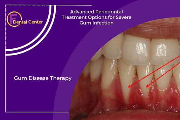 Advanced Gum Disease Treatments for Severe Gum Disease