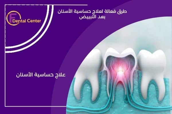 كيفية علاج حساسية الأسنان والوقاية منها بعد تبييض الأسنان