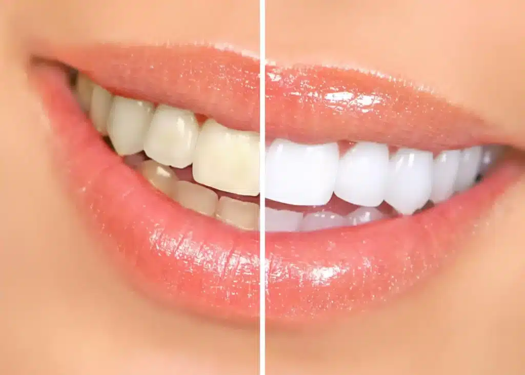 The Ultimate Guide to Teeth Whitening: Methods, Benefits, and What to Expect