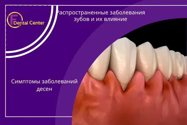 Распространенные стоматологические заболевания
