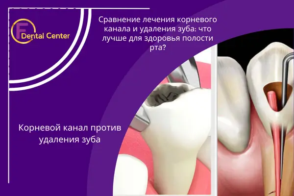 Корневой канал или удаление зуба: Какой вариант вам подходит?