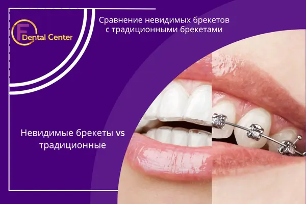 Преимущества невидимых брекетов перед традиционными