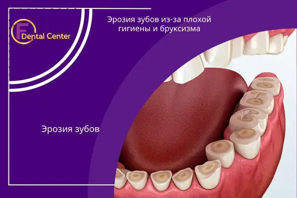 Эрозия зубов, вызванная плохой гигиеной полости рта и бруксизмом