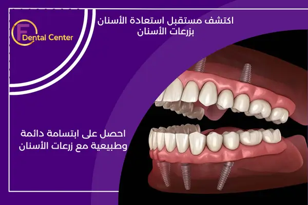 ترميم الأسنان بزراعة الأسنان: أفضل حل دائم للأسنان