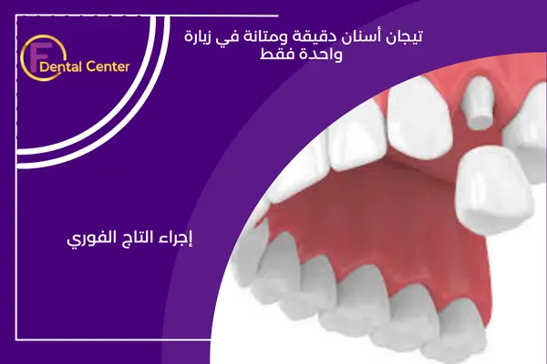 كراون الأسنان في نفس اليوم: الراحة دون مساومة