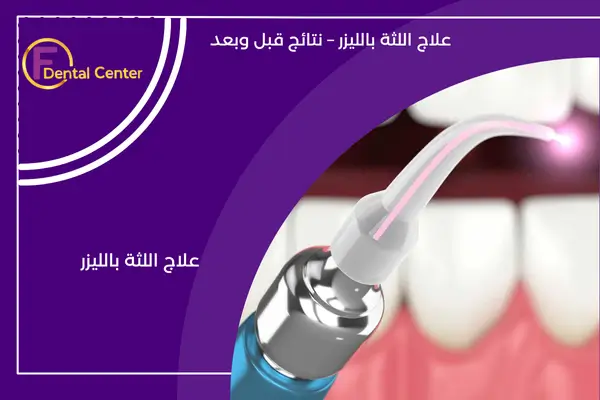 علاج أمراض اللثة بتقنية الليزر: إحداث ثورة في مجال العناية باللثة