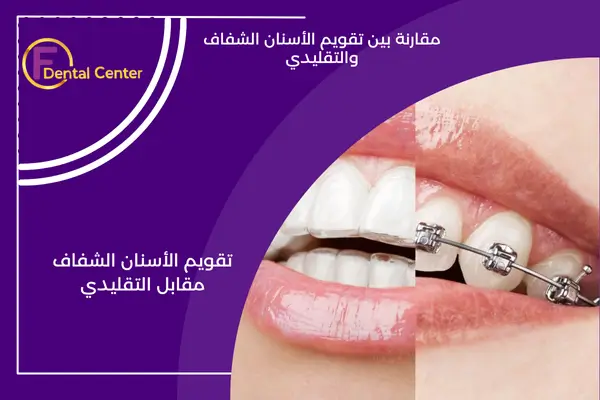 فوائد تقويم الأسنان غير المرئي على تقويم الأسنان التقليدي