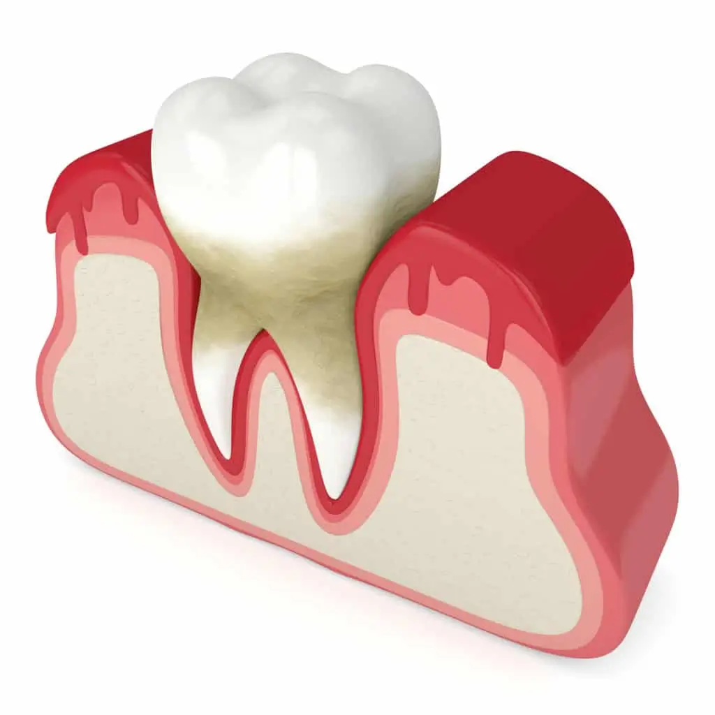 Advanced Periodontics: Modern Solutions for Gum Health and Tooth Preservation
