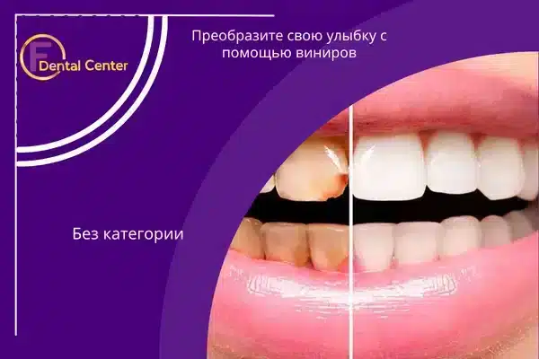 Преобразите свою улыбку с помощью виниров в FDental Center