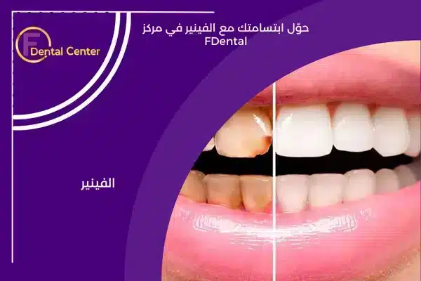 حوّل ابتسامتك مع الفينير في مركز FDental