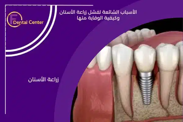 الأسباب الشائعة لفشل زراعة الأسنان وكيفية الوقاية منها