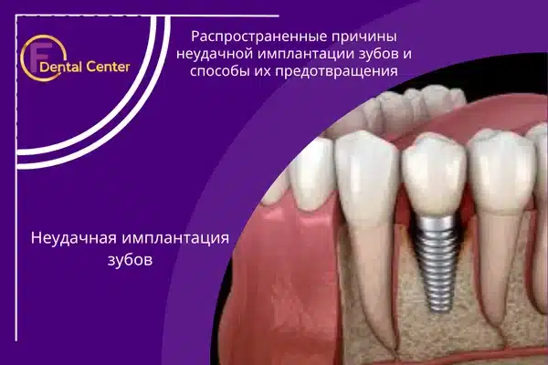 Распространенные причины неудачной имплантации зубов и способы их предотвращения